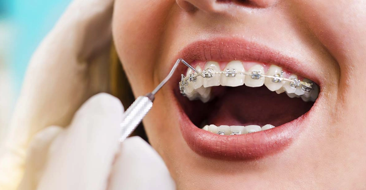 why you shouldn't end your orthodontic treatment early